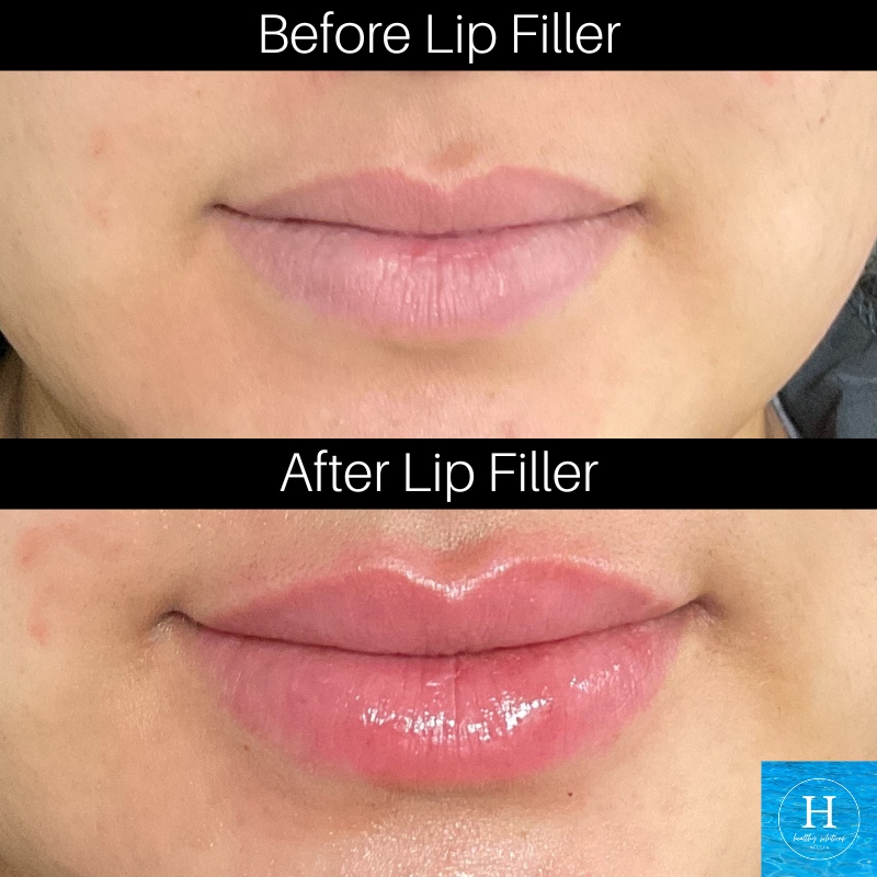 HlthySolMedSpa's tweet image. They say money can't buy happiness, but it can buy lip filler... that's basically the same thing, right? 😆⁠
⁠
💋Enhance your lips natural shape by giving it some extra plump! ⁠
⁠
Book your appointment: ⁠book.mypatientnow.com/practice/aV54zx