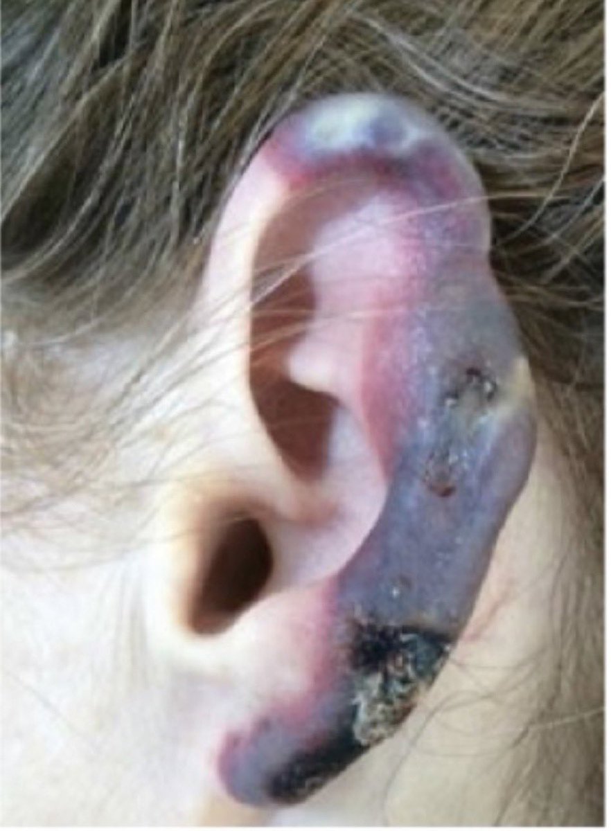 BrownJHM's tweet photo. A patient presented with worsening ear discoloration and pain. Reported regularly using cocaine. Workup notable for low wbc count, positive c-ANCA and p-ANCA. What is the likely diagnosis? H/t @DrCindyCooper #medEd #FOAMed https://t.co/KSiq9WMFC4