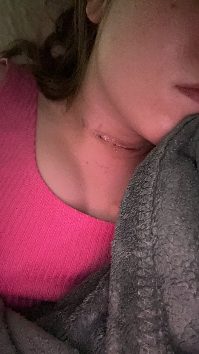 maaaaals's tweet photo. Mini Life update-
I had my thyroid removed because it was doing more harm than good to my body. Hopefully I can start to feel better, but man it’s been a rough couple of years.
I am now recovering at home, in my bed, for a good couple of weeks. https://t.co/VDJqj5lKnk