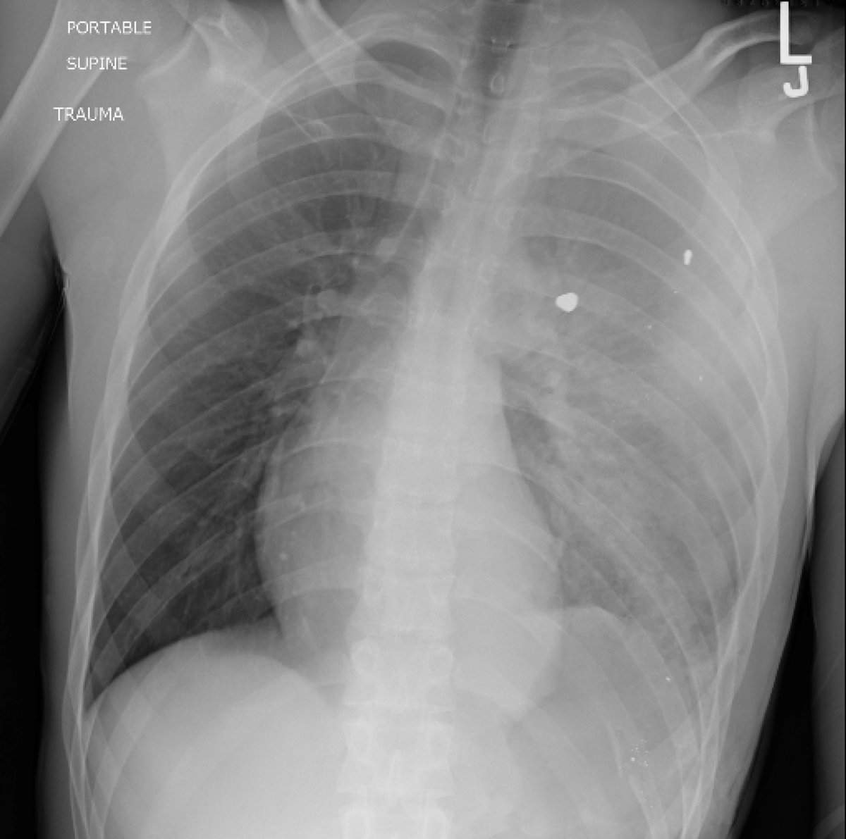 Here’s the Chest X-Ray of a young boy suffering from a condition that is now the #1 cause of death in children and adolescents in the U.S.

What’s the diagnosis?