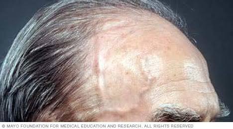 60 Yr old man reports new onset right sided headache, sometimes severe at night for past one week.

What is the treatment of choice ❓️

#MedEd #MedTwitter #RheumTwitter #MedX