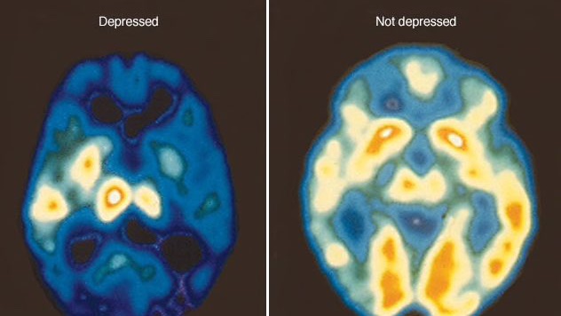 albertolarrains's tweet photo. Respecto a la duda (inentendible) de si la depresión es o no una enfermedad.  Acá imagen (PET) que muestra actividad metabólica cerebral, mostrando la disminución en la depresión. Así que por favor no le diga a alguien que cambie de actitud, porque no se puede, ud solo hace daño. https://t.co/qi1cky07nx
