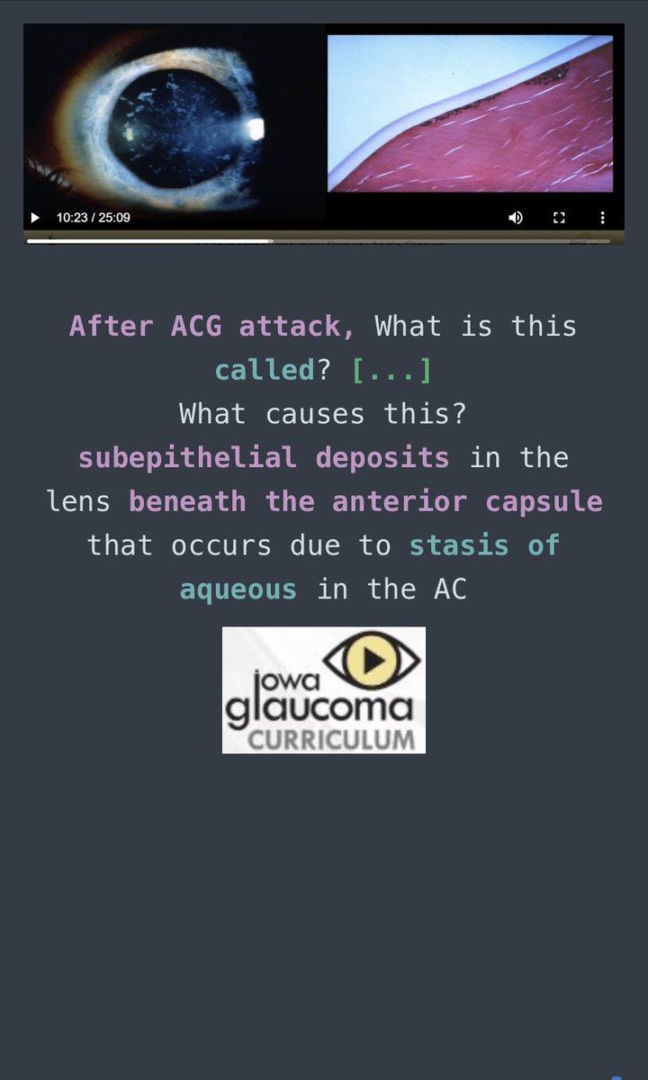 Watch the videos on our <a href="/uiowaeye/">UIowa Eye</a> Glaucoma Curriculum then do the corresponding #Anki cards right after! Efficient workflow for your busy time as a trainee.