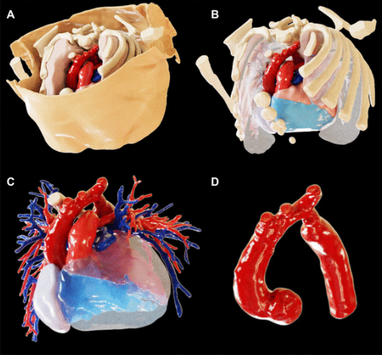SNU Radiology (@snu_rad) on Twitter photo Real-time ray tracing can demonstrate realistic 3D images: Images produces from a CT scan in a 6-day-old newborn with coarctation of aorta.
On-line published in <a href="/RadiologyCTI/">Radiology: Cardiothoracic Imaging</a> this week by Pf. Soon Ho Yoon
pubs.rsna.org/doi/epdf/10.11⦠Real-time ray tracing can demonstrate realistic 3D images: Images produces from a CT scan in a 6-day-old newborn with coarctation of aorta.
On-line published in <a href="/RadiologyCTI/">Radiology: Cardiothoracic Imaging</a> this week by Pf. Soon Ho Yoon
pubs.rsna.org/doi/epdf/10.11ā¦