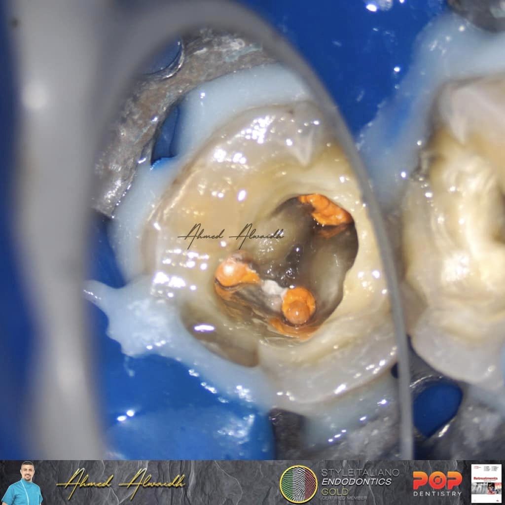 Root canal retreatment of LL6.
Referred patient.
Treatment was done in two visits.
All canals been retreated with Fanta #AFOne #25/06.
NaOCl 3%, EDTA 17%, PUI.
Case courtesy of Dr. Ahmed Alwaidh!
#Fantadental