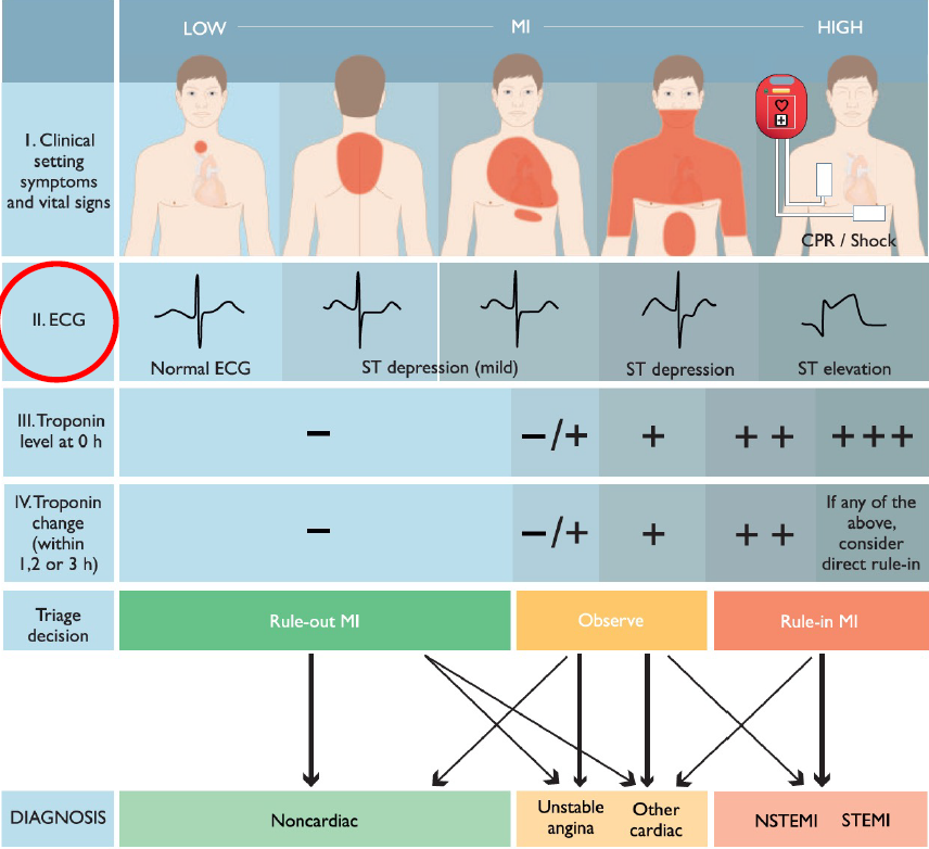A Normal ECG does  NOT   exclude Acute coronary syndrome. 

About 30% of patients with NSTEMI have a Normal ECG.