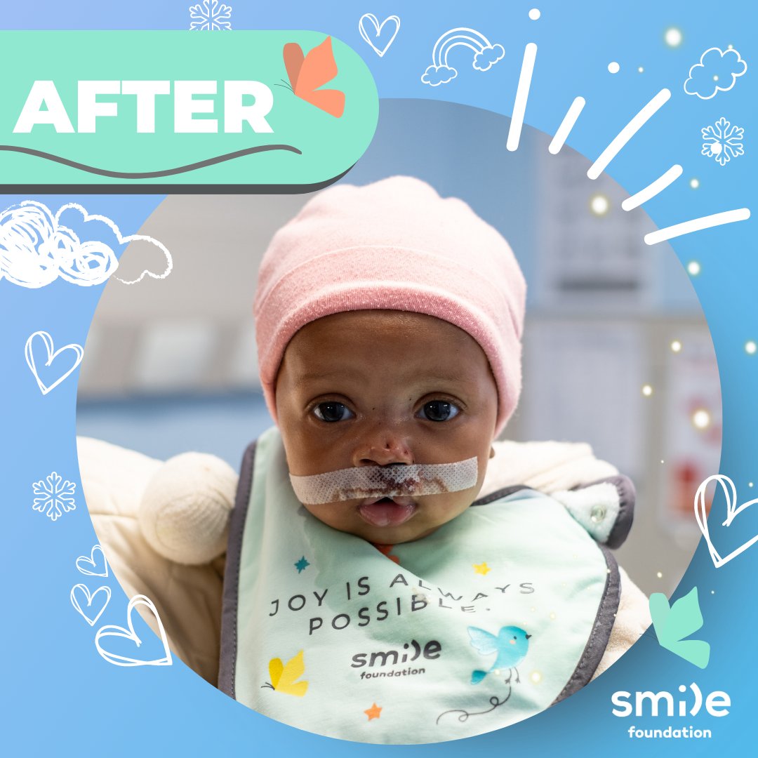 From a smile that could light up a room to an extraordinary transformation! 
Oretilwe received her cleft lip surgery at Dr. George Mukhari Academic Hospital Smile Week. 

#CleftLipSurgery #TransformationTuesday #Smile #MakingMiracles #SmileFoundationSA