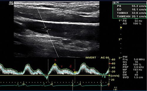 zambo57's tweet photo. Cerebral venous drainage through internal jugular vein | Veins and Lymphatics #Brain #Vein https://t.co/zzOduBDxZb https://t.co/v4iemo2vme