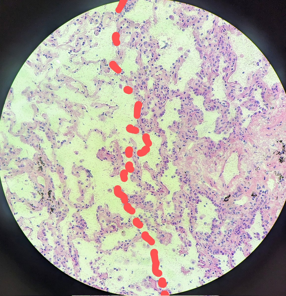 DrSwatiBhardwaj's tweet image. #PathResidents #PathTwitter #PathX Struggling to distinguish between lepidic adeno vs. reactive epithelium on frozens? Look at the junction between normal lung and lesion- Adenocarcinomas show an abrupt transition! I found this page kikoxp.com/posts/20157/pu… by @smlungpathguy