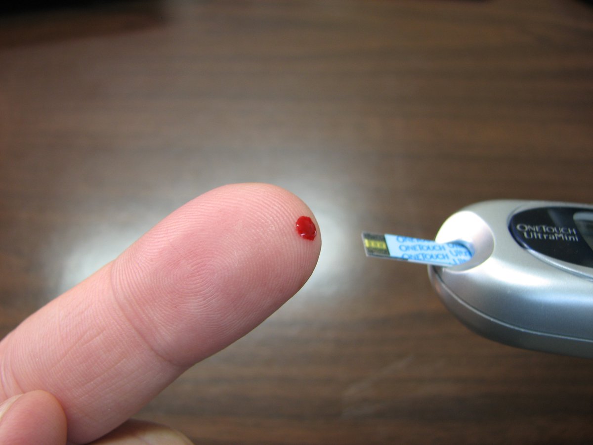 A new study in <a href="/DiabetescareADA/">Diabetes Care, a research journal of the ADA 🌟</a> led by <a href="/yuxia_wei/">Yuxia Wei</a> and <a href="/sofiaejcarlsson/">Sofia Carlsson</a> shows a need for better treatment of latent autoimmune diabetes in adults #LADA to improve glycemic control and reduce complications. 
news.ki.se/need-for-impro…