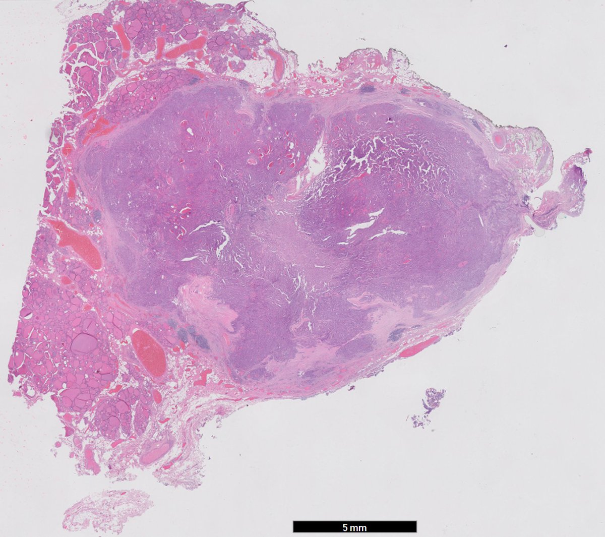 RyCPatologia's tweet photo. ➡️ Nódulo tiroideo de 2 cm.
🔬 Carcinoma papilar, variante convencional.
#rycpath #endopath https://t.co/PkCVvSY3ek