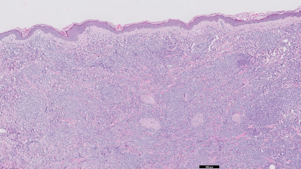 RyCPatologia's tweet photo. ➡️ Nódulos subcutáneos.
➡️ Punch.
🔬 IHQ:
Positivo CD20, CD10, BCL-6, BCL-2, cmyc.
Negativo CD5, ciclina D1, CD30, EBERs.
☑️ Infiltración de dermis e hipodermis por linfoma B difuso de células grandes.
#rycpath #hemepath https://t.co/lcLsZEapFp