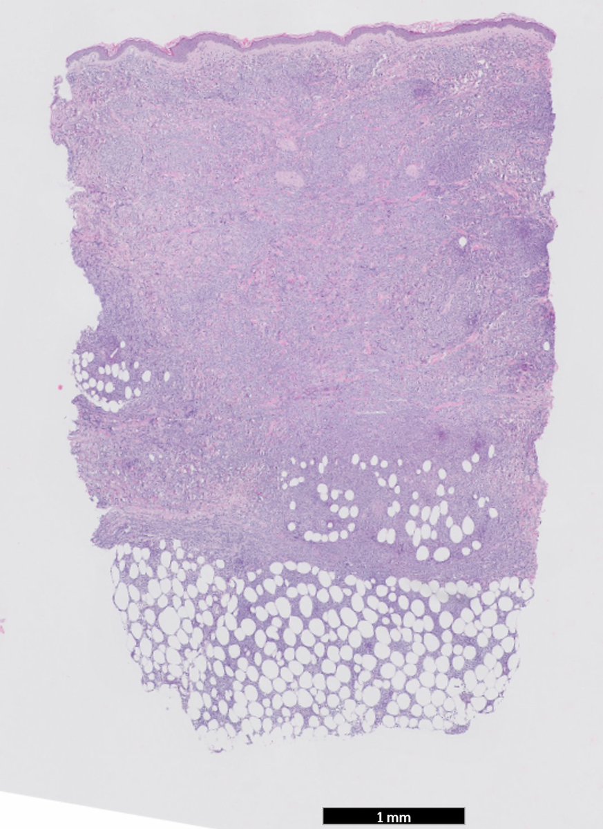 RyCPatologia's tweet photo. ➡️ Nódulos subcutáneos.
➡️ Punch.
🔬 IHQ:
Positivo CD20, CD10, BCL-6, BCL-2, cmyc.
Negativo CD5, ciclina D1, CD30, EBERs.
☑️ Infiltración de dermis e hipodermis por linfoma B difuso de células grandes.
#rycpath #hemepath https://t.co/lcLsZEapFp