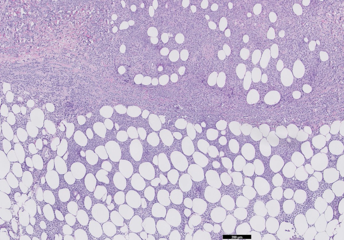 RyCPatologia's tweet photo. ➡️ Nódulos subcutáneos.
➡️ Punch.
🔬 IHQ:
Positivo CD20, CD10, BCL-6, BCL-2, cmyc.
Negativo CD5, ciclina D1, CD30, EBERs.
☑️ Infiltración de dermis e hipodermis por linfoma B difuso de células grandes.
#rycpath #hemepath https://t.co/lcLsZEapFp