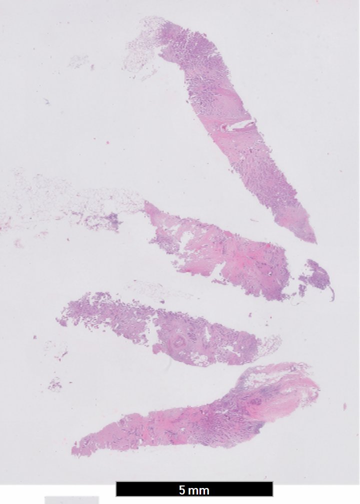 RyCPatologia's tweet photo. ➡️ Nódulo en mama.
🔬 Carcinoma micropapilar.
#breastpath #rycpath https://t.co/LC4Bx3yUf7