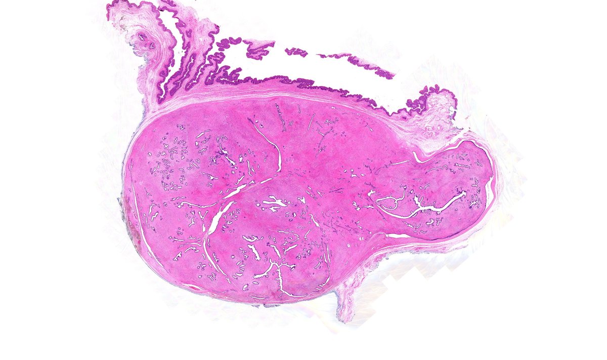 Vulva mass. Diagnosis? More pics & Answer: kikoxp.com/posts/11514 More posts from Dr. Rutland @TristanRutland7 kikoxp.com/tristan_rutlan… #pathology #pathTwitter #medTwitter #gynpath #dermpath