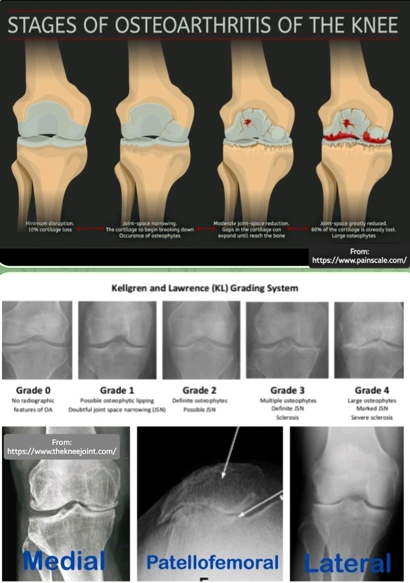 Knee osteoarthritis (OA), also known as degenerative joint disease of the knee, is typically the result of wear &amp; tear and progressive loss of articular cartilage.

✴️Radiographic Findings of OA:
Joint space narrowing
Osteophyte formation
Subchondral sclerosis
Subchondral cysts