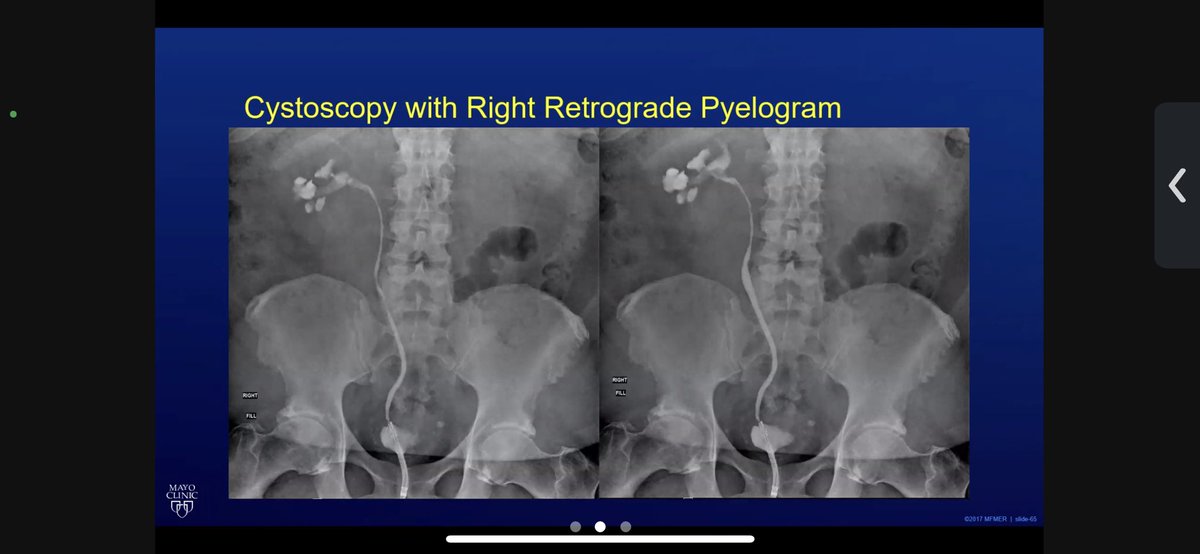 MayoUrology's tweet photo. Today’s #MondayMorningConference question: 40yoM with hx of sacral myxoma excision 5 years ago p/w R flank pain undergoes the following imaging. His WBC and Cr are within normal limits. UA >100 RBC, otherwise normal. See question in next thread. https://t.co/MMq4KgR1a7