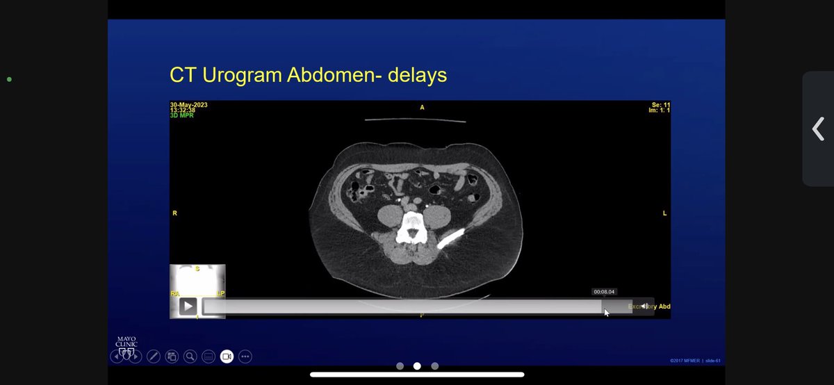 MayoUrology's tweet photo. Today’s #MondayMorningConference question: 40yoM with hx of sacral myxoma excision 5 years ago p/w R flank pain undergoes the following imaging. His WBC and Cr are within normal limits. UA >100 RBC, otherwise normal. See question in next thread. https://t.co/MMq4KgR1a7