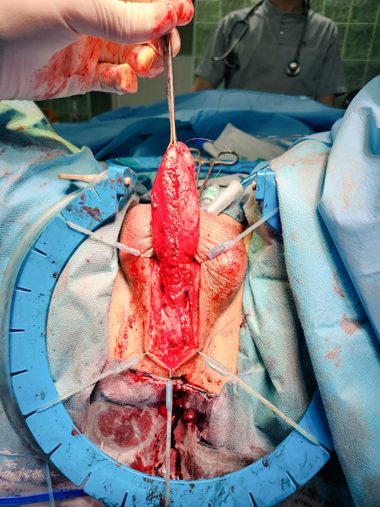 BMG urethroplasty for panutethral stricture (Kulkarni technique). Invagination of penis through perineal midline incision. Thank you @sanjaybkulkarni for creating the technique, thank you Dmitry Nikolavsky @UroRecon for inspiration! #urethroplasty #urethralstricture #Ukraine