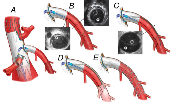 SeminarVascSurg's tweet photo. Intraoperative complications during complex EVAR can be challenging. Check out some troubleshooting pearls (and amazing graphics) from Gustavo Oderich and team in this month's #SemVascSurg! #aortaed @UTHealthHouston @MarioDOria14 @CaitlinWHicks 

https://t.co/ce4oJVAY0e https://t.co/3QO8FpCAr6