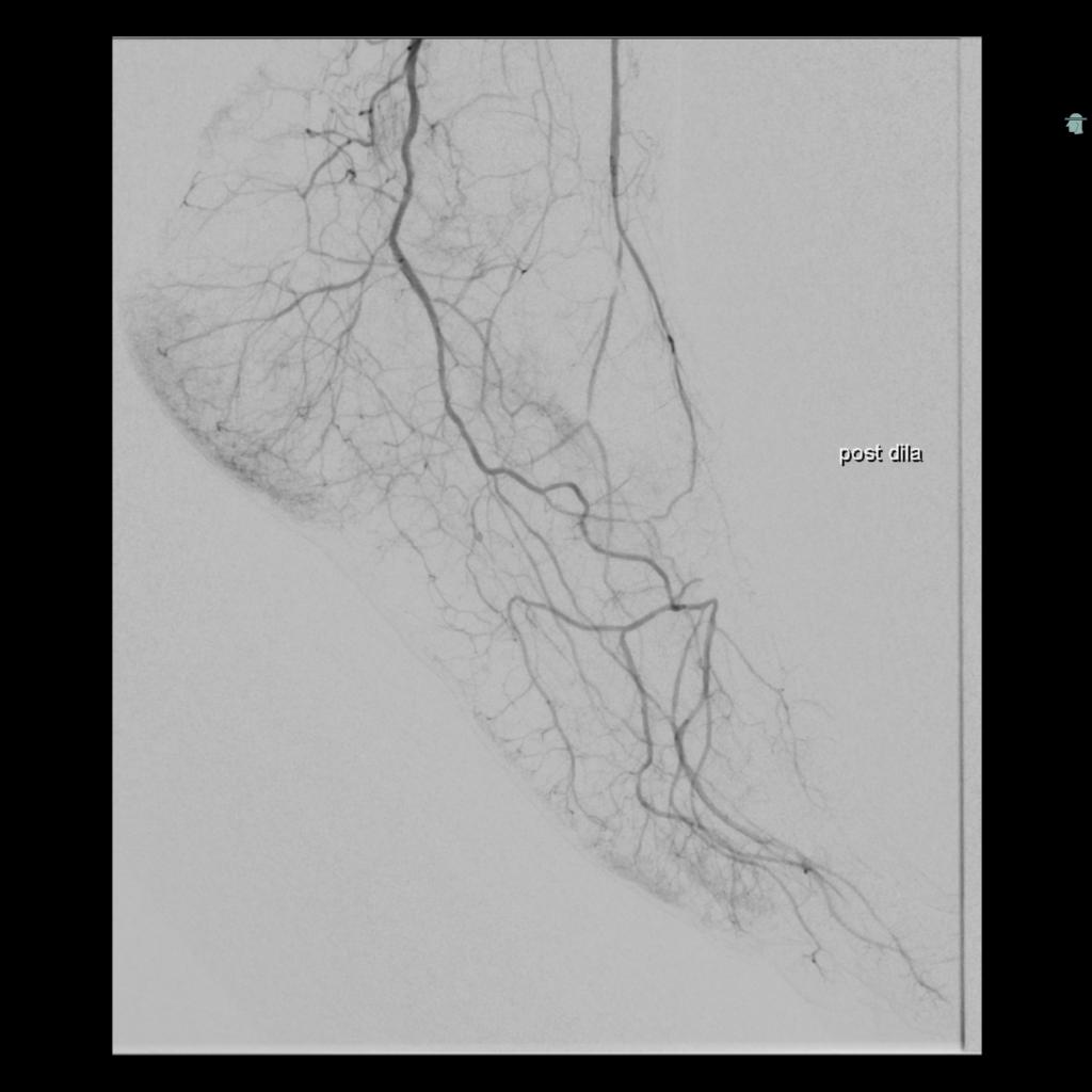 cirsesociety's tweet image. Finally, PTA on the proximal peroneal artery. Looking forward to hearing from the vascular surgeons about the patients' toe pressure measure after PTA later today and the first wound check a week from now. (3/3) #Belowtheknee #interventionalradiology #DFIR