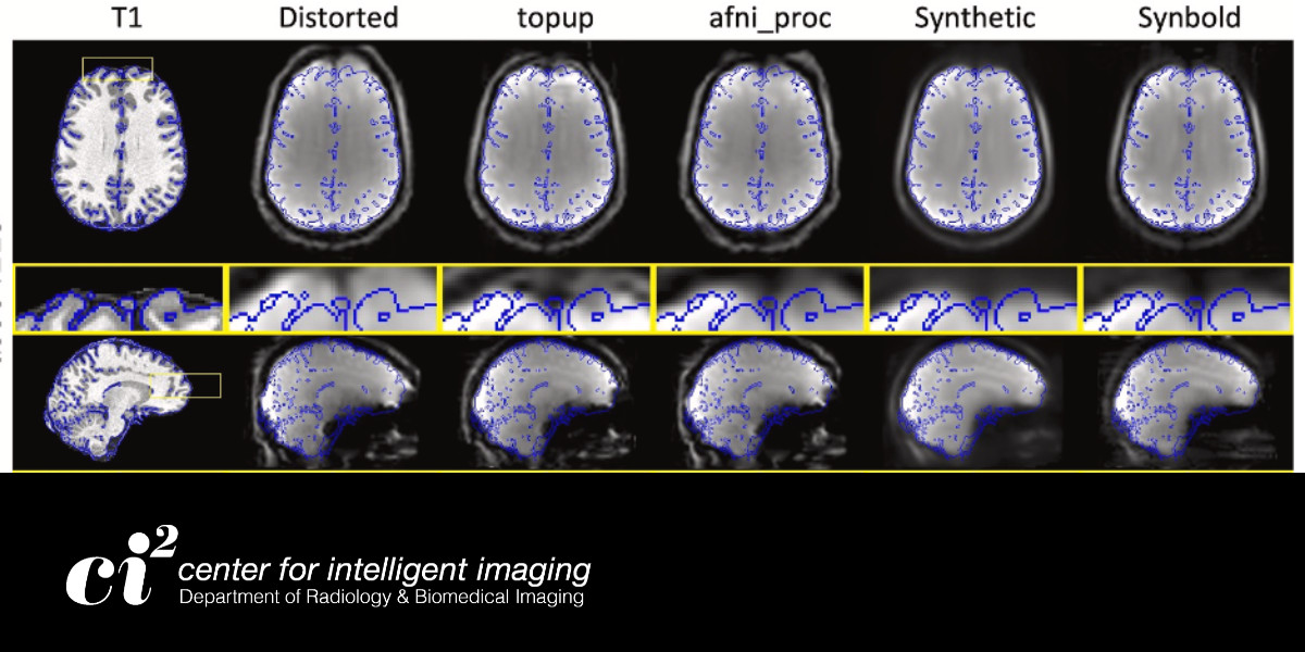Learn about SynBOLD-DisCo, a revolutionary deep learning technique developed by <a href="/UCSF_ci2/">UCSF Center for Intelligent Imaging</a>'s Dr. Joseph Vu, <a href="/UCSFImaging/">UCSF Imaging</a>'s Dr. Salvatore Torrisi &amp; researchers from <a href="/VanderbiltU/">Vanderbilt University</a>, <a href="/Harvard/">Harvard University</a> &amp; <a href="/Sydney_Uni/">University of Sydney</a> in our newest blog post. intelligentimaging.ucsf.edu/news/new-metho…