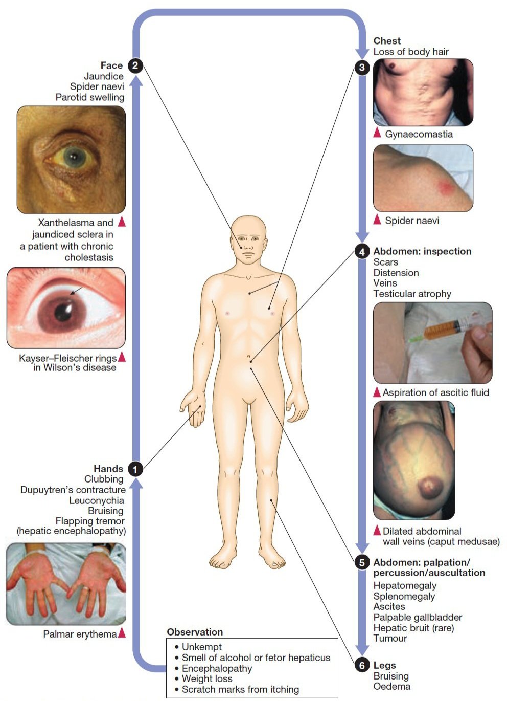 Bruising Caput Medusae bruising-caput-medusae