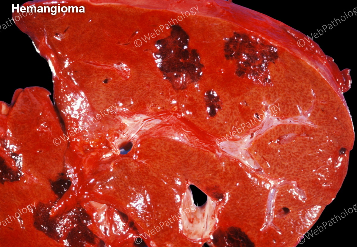 Update in #GIPath #LiverPath Two of the commonest lesions - Hemangioma & Focal Nodular Hyperplasia have been updated. 50 Images. webpathology.com/case.asp?case=…; up next Hepatocellular Adenoma.