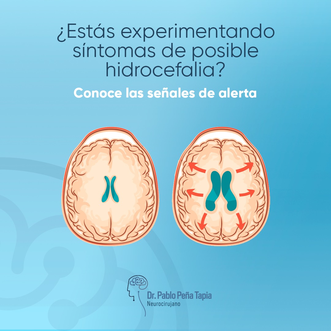 La hidrocefalia es la acumulación de líquido en el cerebro. Dolores de cabeza, náuseas y otros síntomas pueden indicarlo. No ignores estos signos. 

El Dr. Pablo Peña, experto en neurocirugía, puede ofrecer tratamientos personalizados. Contáctanos al 414/072459553 ext. 2400 🧠