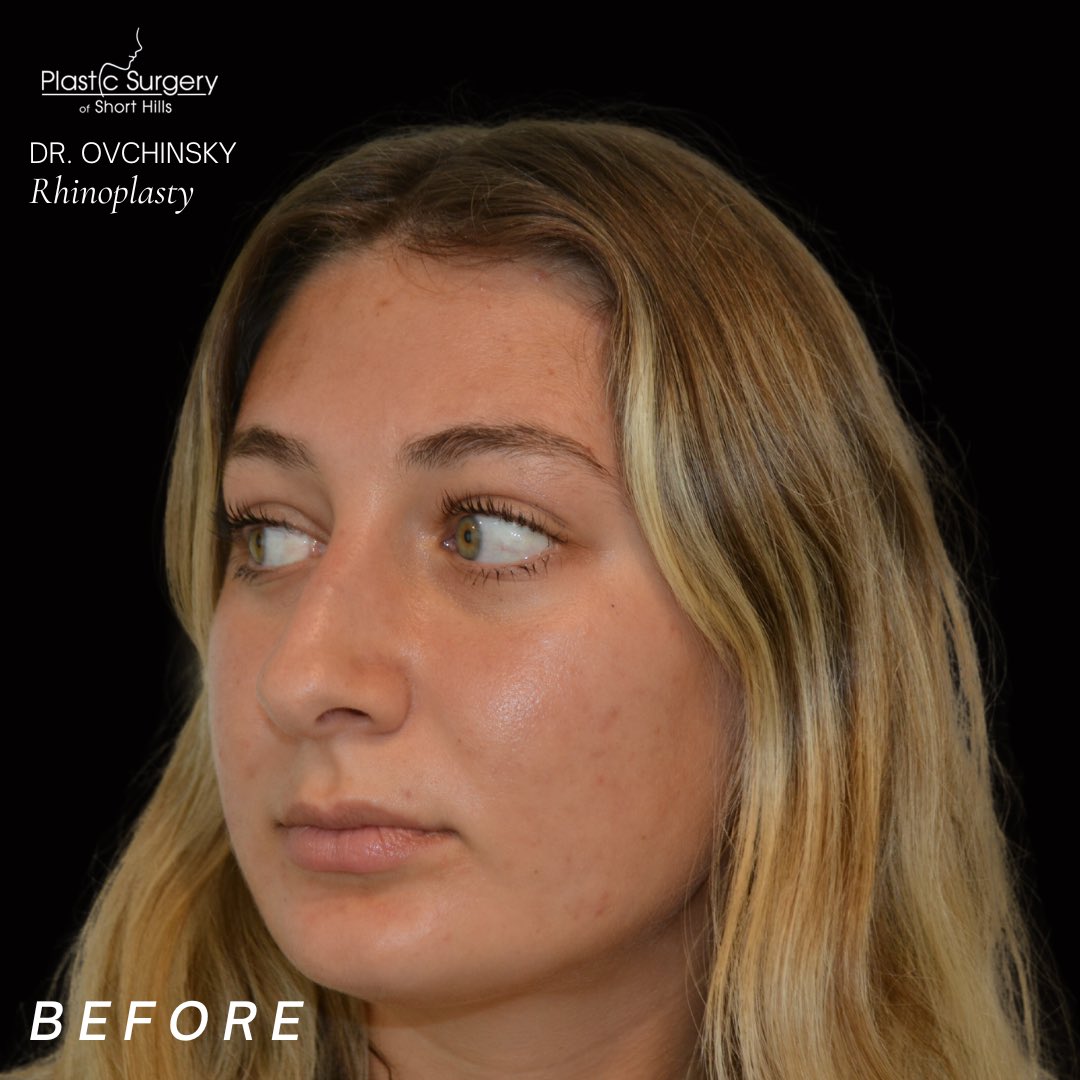 DrOvchinsky's tweet photo. Patient Selfie!😍👃🏼 My patient here is only 3 weeks post op rhinoplasty surgery and looks absolutely amazing! I am so happy to be apart of her journey and help her to feel more confident than ever going into her senior year of college! https://t.co/vrZTOKDX9d