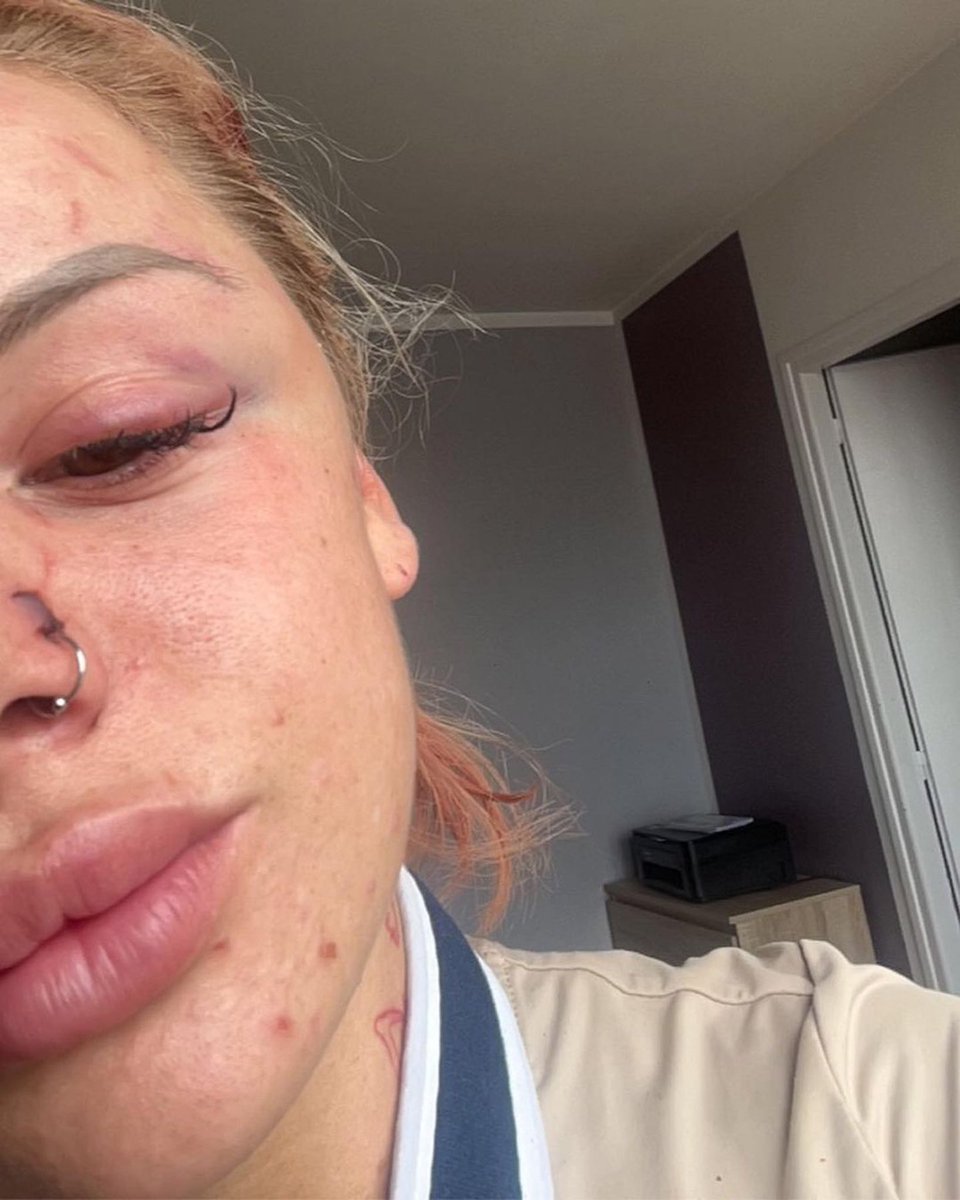 🚨 "J’ai cru que j'allais mourir" : Loana, 22 ans, une jeune influenceuse connue pour ses vidéos YouTube avec sa soeur jumelle Yolande, a été violemment agressée par un homme alcoolisé en sortant de discothèque à #Lille.

Sans raison apparente, l'individu l'aurait rouée de coups