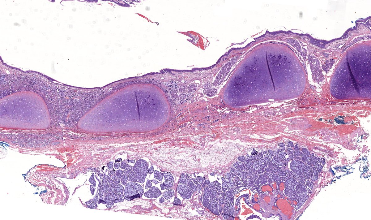 Tracheal mass, young adult. Diagnosis? More pics & Answer: kikoxp.com/posts/9678 More posts from Dr. Rutland @TristanRutland7 kikoxp.com/tristan_rutlan… #pathology #pathTwitter #medTwitter #pulmpath