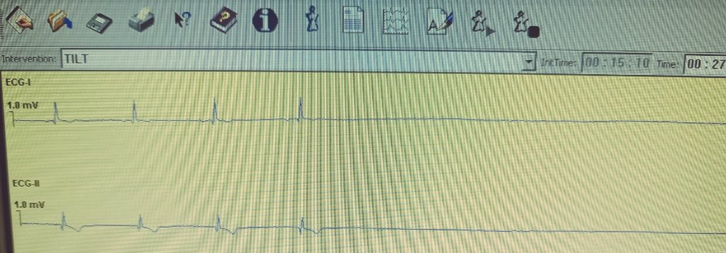 ArritmiasNegrin's tweet photo. 🧐IDENTIFY (2/7🧵)
👉🏼SELECCIONAR EL CASO⭐

👨🏻‍🚒Bombero 46 años con SÍNCOPES REFLEJOS/VAGALES RECURRENTES precisando reubicación laboral🙆🏻

Eco🫀 y #ECG💡normales

TEST DE MESA BASCULANTE🤸🏼‍♂️ #TiltTest patológico con síncope 🫀inhibitorio (respuesta 2B) con ASISTOLIA😶‍🌫️ https://t.co/Za8Dqa874i