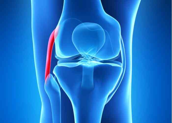 thekneedoc's tweet photo. Typically patients who have a complete #LCLtear will require surgical treatment. This surgical procedure is done as an open procedure in conjunction w/arthroscopy. Dr. LaPrade will replace the torn ligament w/a tissue graft. https://t.co/q4bjvUw1Rk #orthotwitter #sportsmedicine https://t.co/hEBZNzLN4q