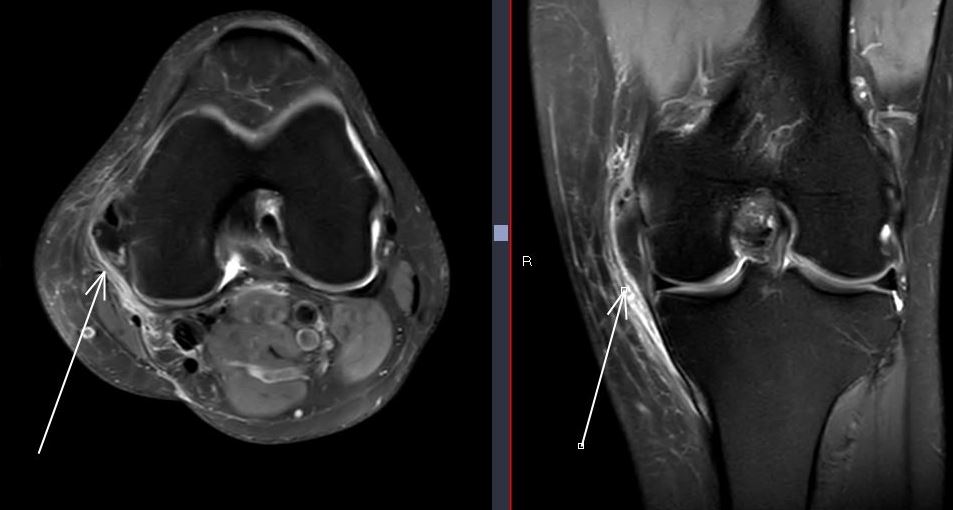 themskarchive's tweet photo. 28/8/2023📊🦴 Periarthritis with Type III calcification in the collateral ligament, migrating to the internal epicondyle &amp; anserine bursa. Plus peritendinitis of the pes anserinus. Unveiling the complex world of long-standing knee pain. #MSK #Knee @pepelermarx https://t.co/79EGE3tn4N