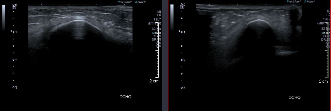 themskarchive's tweet photo. 28/8/2023🧩🦵 Another interesting case of calcifying periartritis of the knee, early stage. Type I calcification along the capsular plane of the collateral ligament, minimal pericapsular edema. No anserine bursitis, no bone marrow edema. #MSK @pepelermarx @drwillyjara https://t.co/G6F22QhHlh