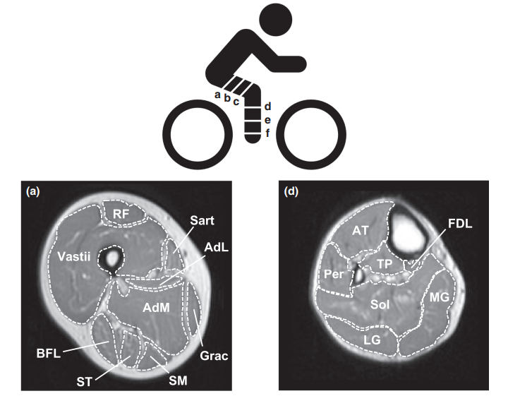 jacksonfyfe's tweet photo. Is cycling enough to stimulate muscle growth in older men?

➖20–45 min per session
➖60%–80% heart rate reserve
➖3–4 sessions per week

After 12 weeks, VO2max increased by +13%.

But changes in muscle size were variable.

Some got bigger:

➖ Vastii +7%, Sartorius +6%

Others got smaller:

➖ Biceps femoris LH -5%, Adductor longus -6%

And most didn’t change (including none in the lower leg):

➖ Rectus femoris (-3%), Gracilis (+3%), Gastroc/soleus (-2%)

https://t.co/kOXSNmVupu
