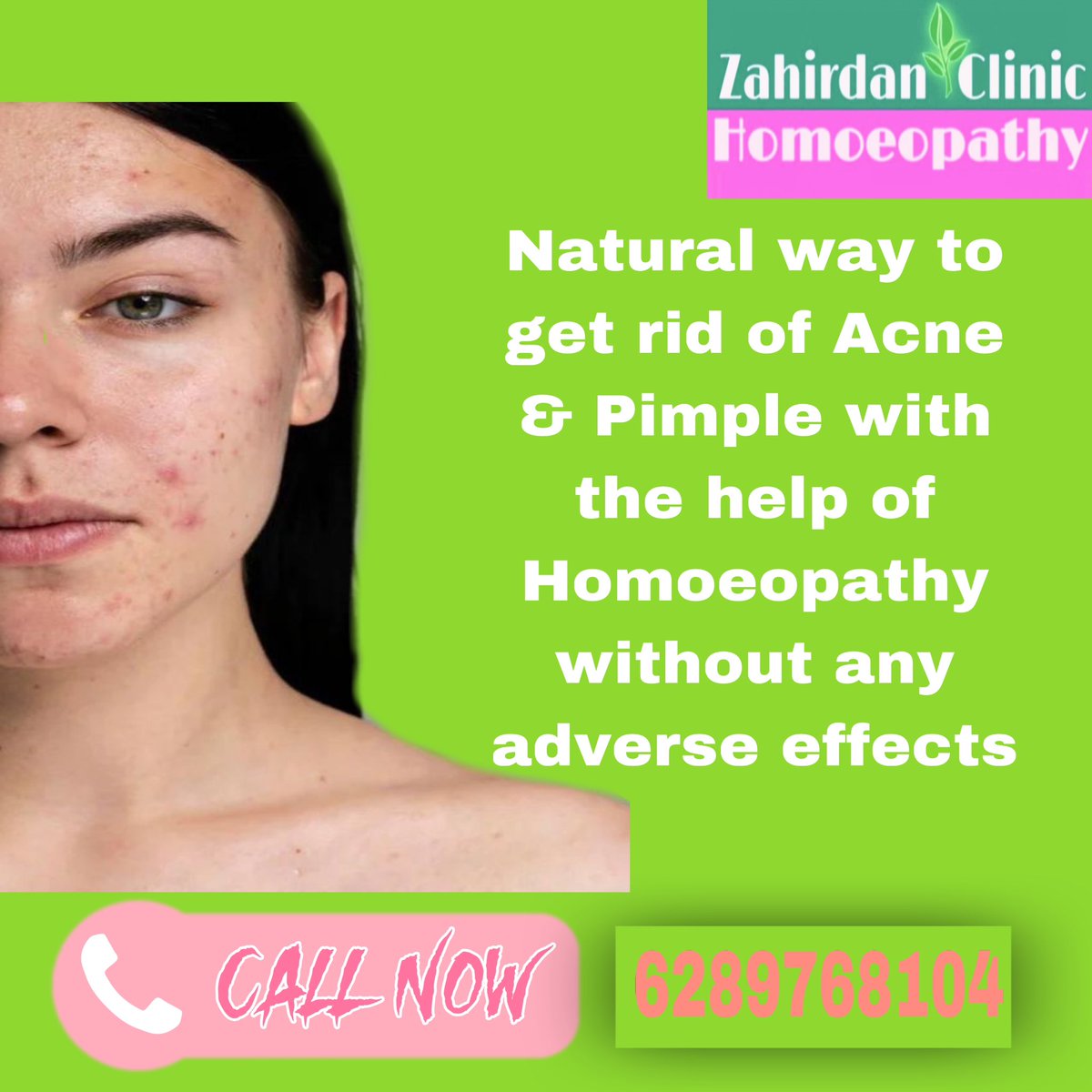 #zahirdanclinic #homeopathytreatment #homoeopathicmedicine #homoeopathy #acne #acnetreatment #acnescars #acneskincare #acneproneskin #pimple #pimplesremover #pimpletreatment