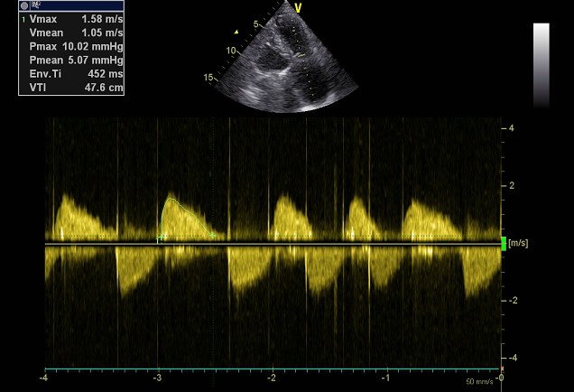 Irina67790690's tweet photo. And another severe TV stenosis and severe TV regurgitation. 
Patient after AV and MV replacement in 2005. Rheumatic heart disease. 
Significant dilatation of RA and IVC.
#Cardiotwitter #echofirst https://t.co/c2oqBecplR