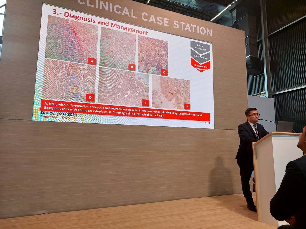 Montserrat Carrillo (@dramcarrillo9) on Twitter photo Presentación de tres casos clínicos y dos abstracts de Cardio-oncología ❤️🦀
HC CMN SXXI 🇲🇽
#ESCCongress2023
#Amsterdam
<a href="/DLeocachinp/">Daniela Leocachín</a> <a href="/ValdoCasMtz/">Dr Dolce</a> <a href="/jjar94/">Jesús A.</a> <a href="/axelhiram/">Axel Hiram Hdz</a> <a href="/JessicaBocardo1/">Jessica Bocardo</a> Presentación de tres casos clínicos y dos abstracts de Cardio-oncología ❤️🦀
HC CMN SXXI 🇲🇽
#ESCCongress2023
#Amsterdam
<a href="/DLeocachinp/">Daniela Leocachín</a> <a href="/ValdoCasMtz/">Dr Dolce</a> <a href="/jjar94/">Jesús A.</a> <a href="/axelhiram/">Axel Hiram Hdz</a> <a href="/JessicaBocardo1/">Jessica Bocardo</a>