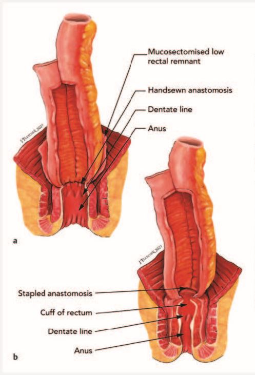 endoscopyjrnl's tweet photo. Study: Familial  adenomatous polyposis: long-term outcomes of pouch surveillance and risk of  neoplasia

https://t.co/Wl8JvzpQhK

Roshani V. Patel, Kit Curtius, Ripple Man et al. https://t.co/NAUle0hE5f