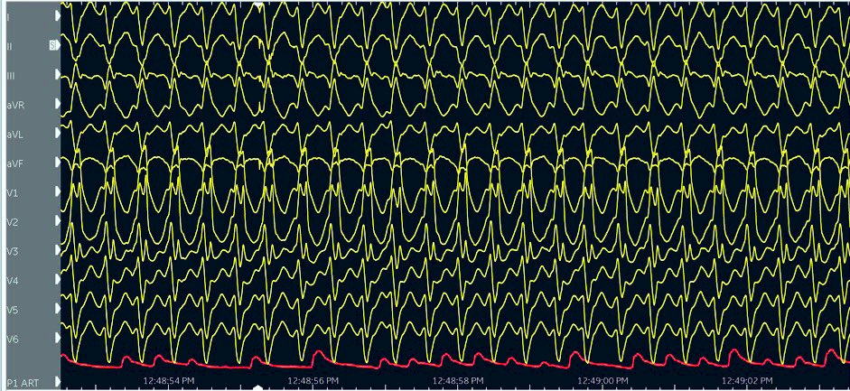 BurgZammit's tweet photo. The best patient care often comes from great collaborations. @MatthewMerciecaBalbi presenting our first case of #VTablation on #PulseCath #iVAC2L pMCS during #ESCCongress2023.
With @SammutM_MD @RobertGXuereb and @WaelHaidar @AlbertVanZyl from @AbbottCardio
@MaterDeiMalta
🧵 https://t.co/hARYTB3BQi
