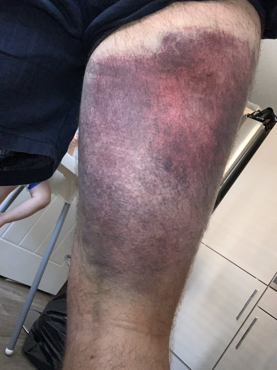 Most recent picture of the ever growing bruise 🤣