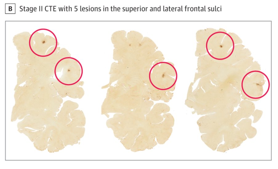 ChrisNowinski1's tweet photo. The new study from @bu_cte  today shows #CTE is far too common among amateur athletes. 
41% of 152 athletes who died before 30 had it, most of whom played for fun. 
I've shared my full thoughts on the study at the link, including what needs to happen next. https://t.co/FFdq7GLFPq https://t.co/jWJ7OJ41t1