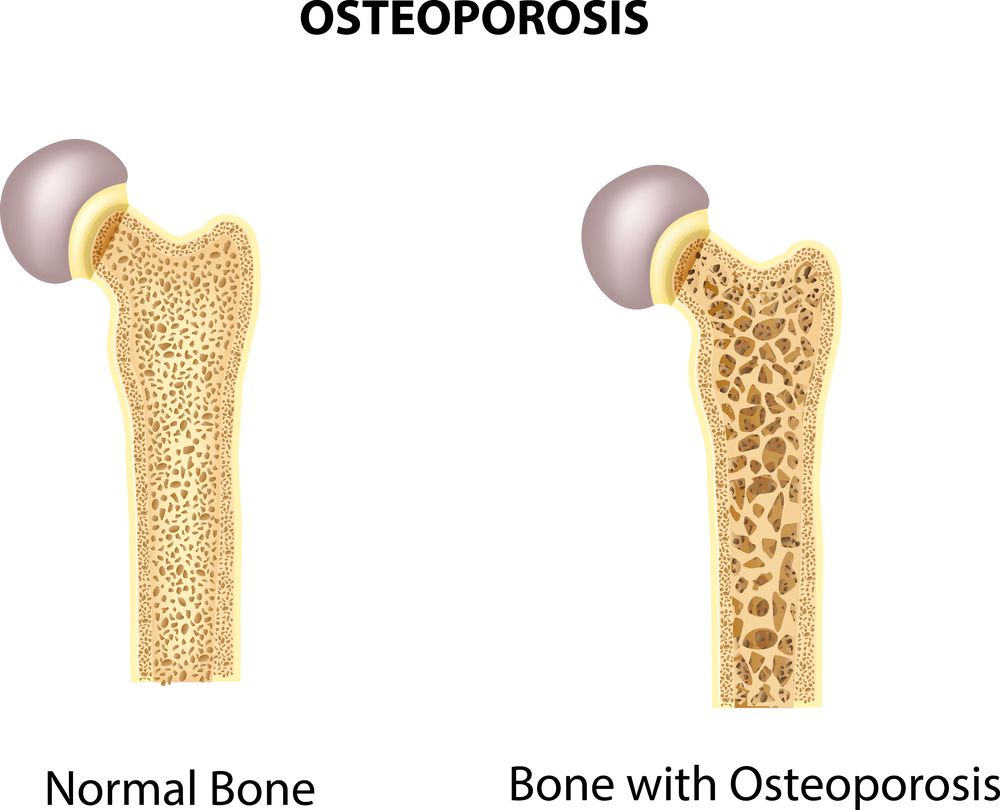 Ar_bones's tweet photo. I was pleased finding Women against Osteoporosis @WOsteopenia, hoping to reach women with osteoporosis &amp; to discuss treatments &amp; how they cope with it, but they have only 9 posts &amp; 25 followers!
@leahmatcham @patriciaarln @bonebalance @drsimonegold @AMWADoctors @bonehealthBHOF https://t.co/tzToKccqq5