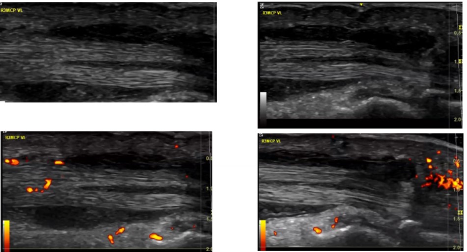 USSONAR (@ussonar_rh) on Twitter photo Dr Diane Mar kicks off the #Lupus Imaging and Therapeutics webinar series with a comprehensive discussion of MSK imaging findings in lupus.
#rheumtwitter #SLE #meded #RhMSUS
Thanks <a href="/AstraZeneca/">AstraZeneca</a> for supporting this educational series Dr Diane Mar kicks off the #Lupus Imaging and Therapeutics webinar series with a comprehensive discussion of MSK imaging findings in lupus.
#rheumtwitter #SLE #meded #RhMSUS
Thanks <a href="/AstraZeneca/">AstraZeneca</a> for supporting this educational series
