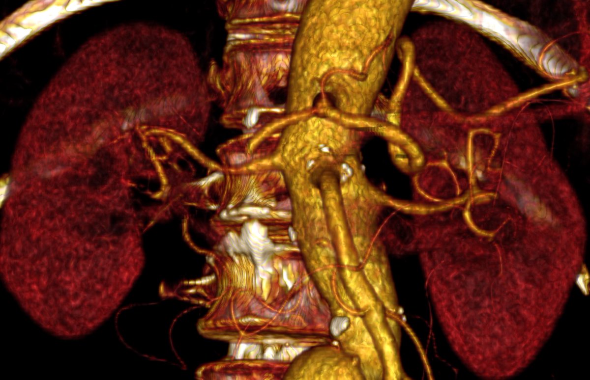 André Brito Queiroz (@andrebrq) on Twitter photo Origin of the SMA below the renal arteries. Two cases today. #AortaEd
How often do you find this? <a href="/MGibreel1/">Mohamed Gibreel (@MGibreel1)</a> <a href="/arianepleal/">Ariane Pacheco Leal</a> <a href="/RKTvascular/">Prof Ramesh K Tripathi</a> <a href="/motarodrigos/">Rodrigo Mota</a> Origin of the SMA below the renal arteries. Two cases today. #AortaEd
How often do you find this? <a href="/MGibreel1/">Mohamed Gibreel (@MGibreel1)</a> <a href="/arianepleal/">Ariane Pacheco Leal</a> <a href="/RKTvascular/">Prof Ramesh K Tripathi</a> <a href="/motarodrigos/">Rodrigo Mota</a>