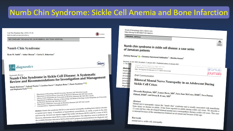 'Numb chin syndrome' , or mental nerve neuropathy, refers to unilateral or bilateral numbness of the lower lip and chin in distribution of the mental or inferior alveolar nerves. It can have a variety of causes. Vaso-occlusion in the maxillofacial region of sickle cell patients