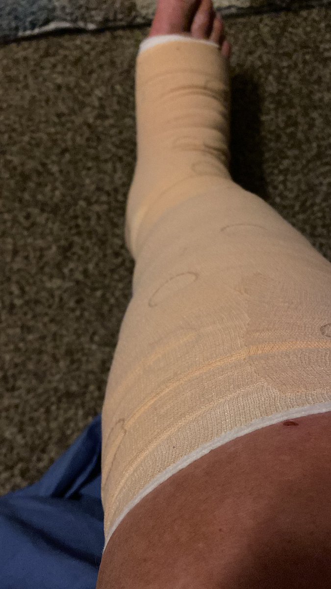 First day of trying to fix the venous insufficiency! Hurts like a mofo and burns like a match on your skin. Wish me luck, lord know I need some good luck!!!